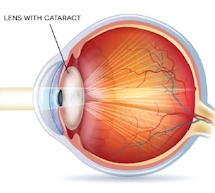 How Cataracts are Formed